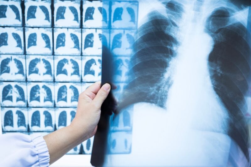 Woman doctor compare patient chest x-ray and CT scan film before treatment.Image lung at radiology department in hospital.Covid-19 scan body xray test detection for covid virus epidemic spread concept.