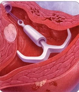 IUD